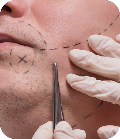 Beard Transplant in Boca Raton