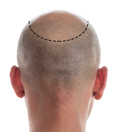 FUT Hair Transplant (Follicular Unit Transplantation)