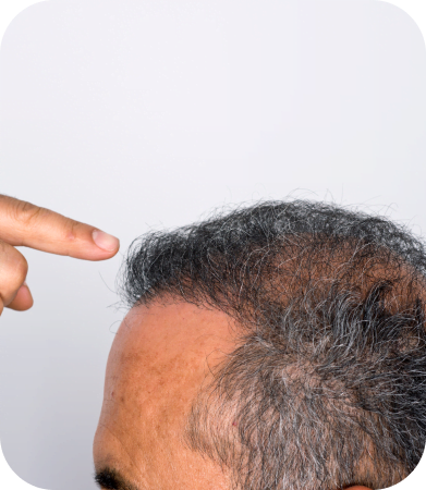 Virtual Consultation for Hair Transplants