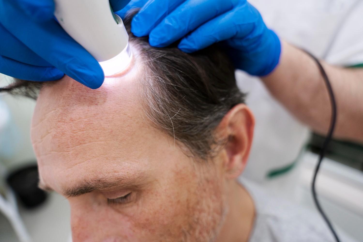 fast fue recovery treatment